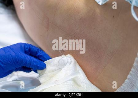 Pregnant woman with lumbar epidural catheter resulting from epidural administration in preparation for labour Stock Photo