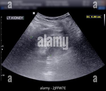 Ultrasound of urinary bladder or KUB for screening renal and bladder ...