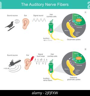 The auditory nerve fibres, comparison sound source 2 types which it is sent the signal sound to the auditory nerve fibres affecting the human brain. Stock Vector