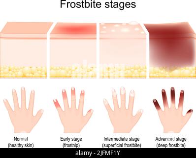 Frostbite, skin freezing concept icon. Low temperature effect, winter ...