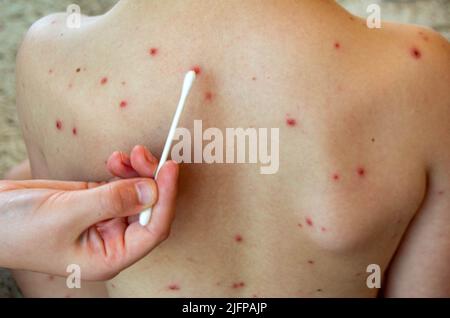 Natural vaccination. Contagious disease.  Stock Photo