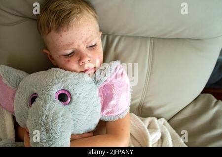 Natural vaccination. Contagious disease.  Stock Photo