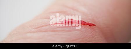 Injured persons finger with bleeding open cut wound Stock Photo