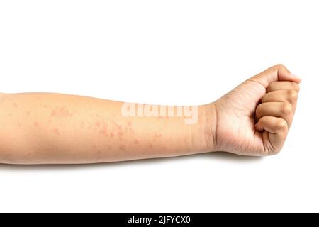 People getting red rash on the arm skin isolated on white background. Skin care concept Stock Photo