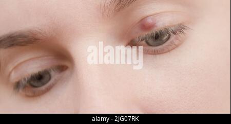 Painful Red Upper Eyelid With Onset Of Stye Infection. Close-up Of An ...