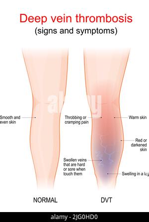 deep vein thrombosis is a blood clot in a vein, usually the leg. Healthy leg, and leg with DVT. Sign and symptoms of thrombophlebitis. Blood vessel Stock Vector