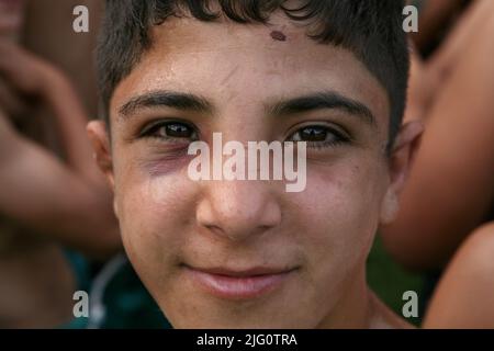 Kırkpınar (Turkish Oil Wrestling). Young wrestler with a black eye pictured during the 648th Kırkpınar Tournament in Edirne, Turkey, on 3 July 2009. Stock Photo