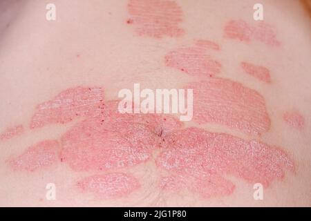 Scaly Burning Rash Acute psoriasis on the stomach in a man, severe redness on the skin, an ...