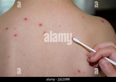 Natural vaccination. Contagious disease.  Stock Photo