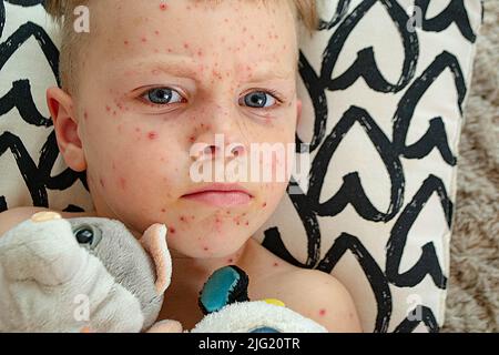 Natural vaccination. Contagious disease.  Stock Photo