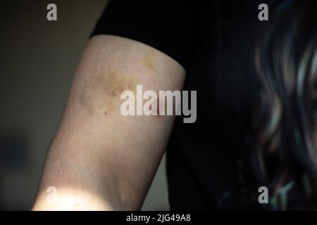 Bruise on female skin. Injection bruises after Pulmonary Embolism