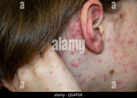 Varicella virus or Chickenpox bubble rash on child Stock Photo