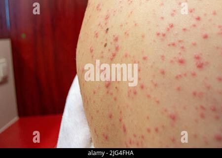 Varicella virus or Chickenpox bubble rash on child Stock Photo