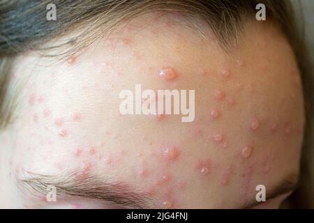 Varicella virus or Chickenpox bubble rash on child Stock Photo