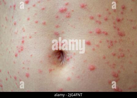 Varicella virus or Chickenpox bubble rash on child Stock Photo