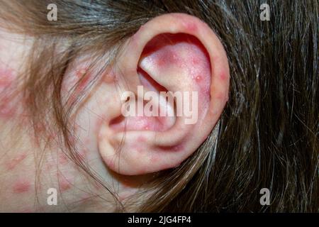 Varicella virus or Chickenpox bubble rash on child Stock Photo