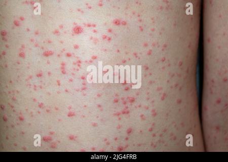 Varicella virus or Chickenpox bubble rash on child Stock Photo