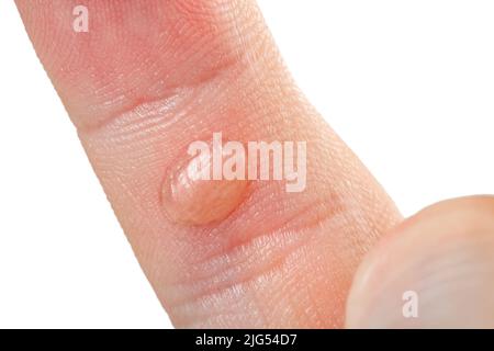 Chafed skin hi-res stock photography and images - Alamy