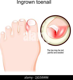 Ingrown toenail. Human foot. Close-up of red, painful and swollen toe. vector illustration Stock Vector