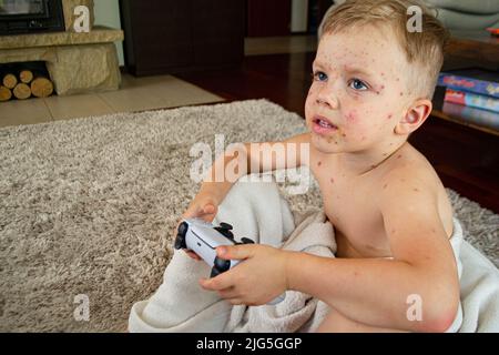 Natural vaccination. Contagious disease.  Stock Photo