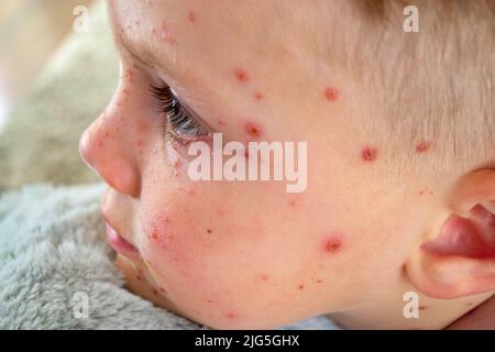 Natural vaccination. Contagious disease.  Stock Photo