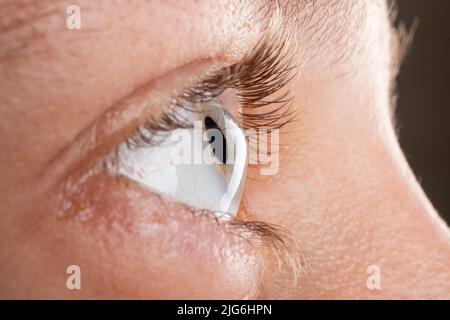 female eye diagnosed with keratoconus corneal thinning. Stock Photo