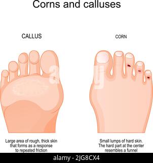 Corns on toe and calluses on sole. comparison and differences human's feet with corns and callus. Large area and Small lumps of rough, thick skin th Stock Vector