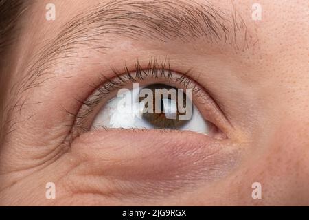 keratoconus disease of the cornea of  the eye macro, fatigue corneal thinning. Stock Photo
