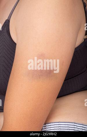 Hematoma on the female butt leg. Woman buttocks bruise. Domestic