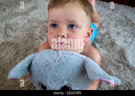 Natural vaccination. Contagious disease.  Stock Photo