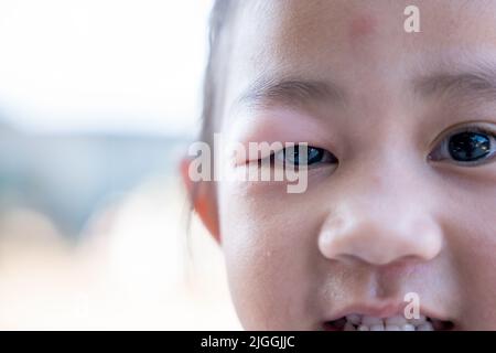 Stye Eye diseases. Closed Asian kid little girl eye with sty, eyelid abscess ophthalmic hordeolum Stock Photo