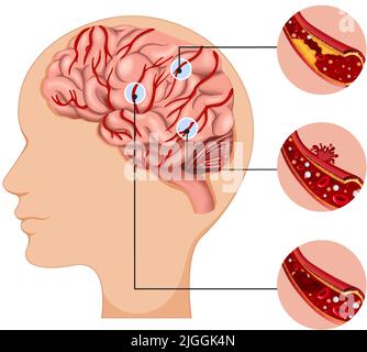 Human with common types of stroke infographic illustration Stock Vector