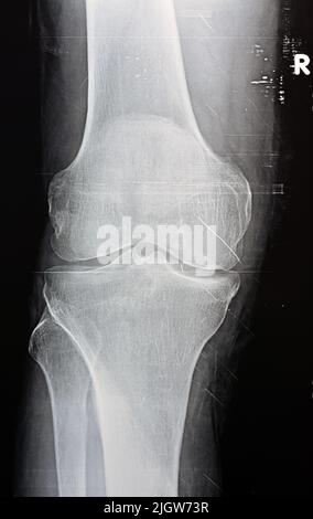 Plain X ray of the right knee shows apparent joint osteoarthritis according to Kellgren and Lawrence system for classification of osteoarthritis with Stock Photo