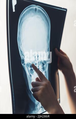 Vertical closeup shot of a skull X-ray illuminated by a special whiteboard. Doctor's finger pointing on a chick area. . High quality photo Stock Photo