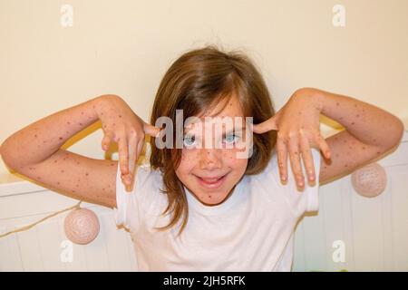 Natural vaccination. Contagious disease. Sick child with chickenpox. Varicella virus or Chickenpox bubble rash on child body and face. High quality photo Stock Photo