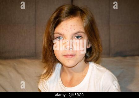 Natural vaccination. Contagious disease. Sick child with chickenpox. Varicella virus or Chickenpox bubble rash on child body and face. High quality photo Stock Photo