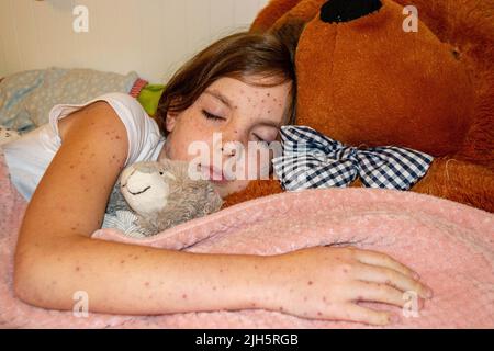 Natural vaccination. Contagious disease. Sick child with chickenpox. Varicella virus or Chickenpox bubble rash on child body and face. High quality photo Stock Photo