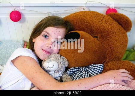 Natural vaccination. Contagious disease. Sick child with chickenpox. Varicella virus or Chickenpox bubble rash on child body and face. High quality photo Stock Photo