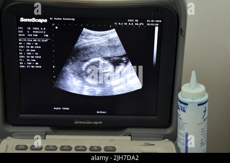 Cairo, Egypt, January 24 2018: A monitor of a portable ultrasonography showing the head of a fetus with a gestational age GA 18 weeks and 4 days durin Stock Photo