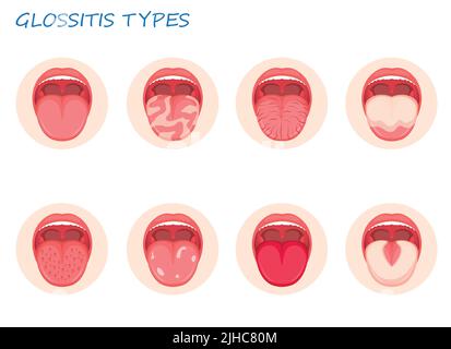 Types glossitis. Inflammatory disease tongue, vector illustration Stock Vector