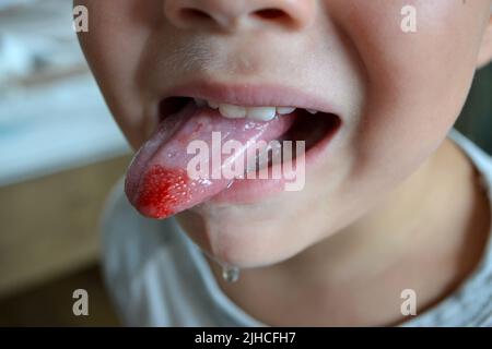 Child's bitten tongue. Close-up of lips, tongue, protrusion of blood Stock Photo
