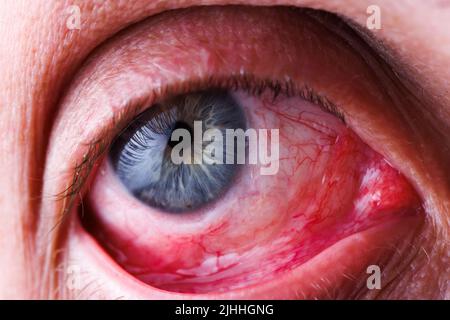 gray eye of caucasian male with red capillary mesh, lower eyelid pulled back Stock Photo