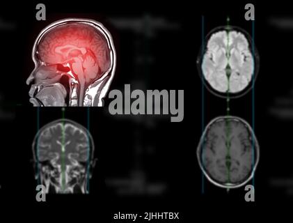MRI brain axial T1W plane sagittal and axial view for detect stroke ...