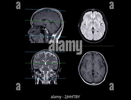 MRI  brain compare axial, coronal and sagittal plane  for detect stroke disease and Brain tumors and cysts. Stock Photo