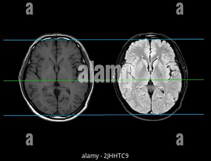 MRI brain compare axial, coronal and sagittal plane for detect stroke ...