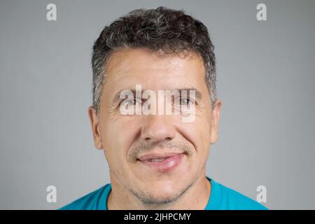 Allergic reaction on a man's lip after a bee sting Stock Photo