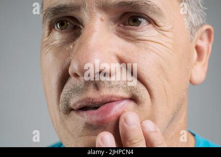 Allergic reaction on a man's lip after a bee sting Stock Photo