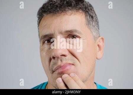 Allergic reaction on a man's lip after a bee sting Stock Photo