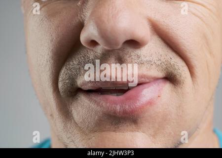 Allergic reaction on a man's lip after a bee sting Stock Photo