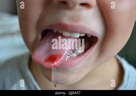 Child's bitten tongue. Close-up of lips, tongue, protrusion of blood Stock Photo